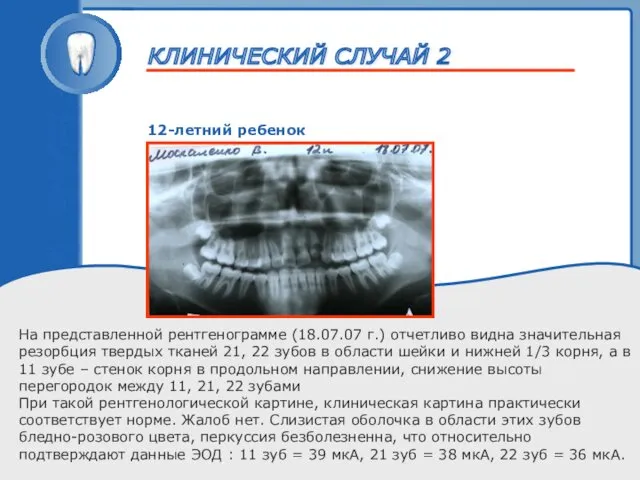 ТРАВМА ЗУБА 12-летний ребенок На представленной рентгенограмме (18.07.07 г.) отчетливо видна значительная резорбция