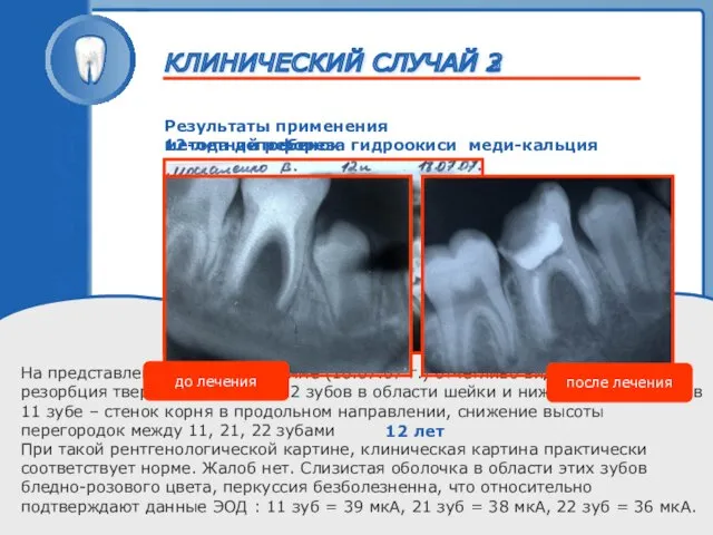 ТРАВМА ЗУБА 12-летний ребенок На представленной рентгенограмме (18.07.07 г.) отчетливо видна значительная резорбция
