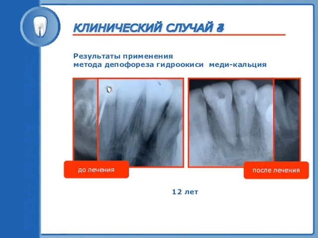 ТРАВМА ЗУБА Результаты применения метода депофореза гидроокиси меди-кальция до лечения после лечения КЛИНИЧЕСКИЙ