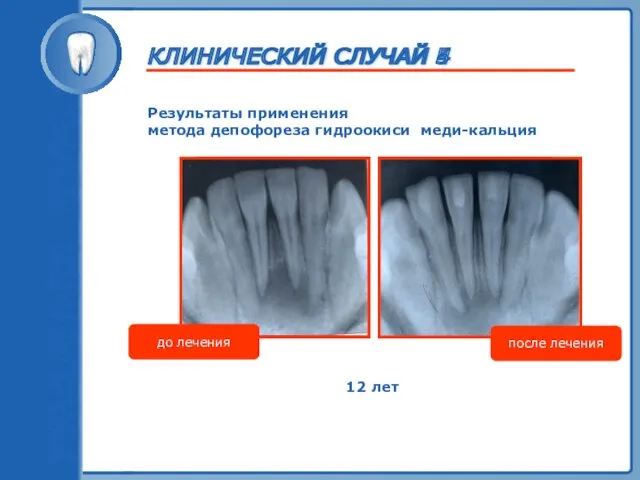 ТРАВМА ЗУБА Результаты применения метода депофореза гидроокиси меди-кальция до лечения после лечения 12