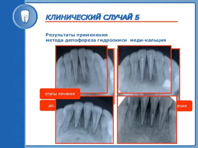 ТРАВМА ЗУБА Результаты применения метода депофореза гидроокиси меди-кальция до лечения после лечения этапы