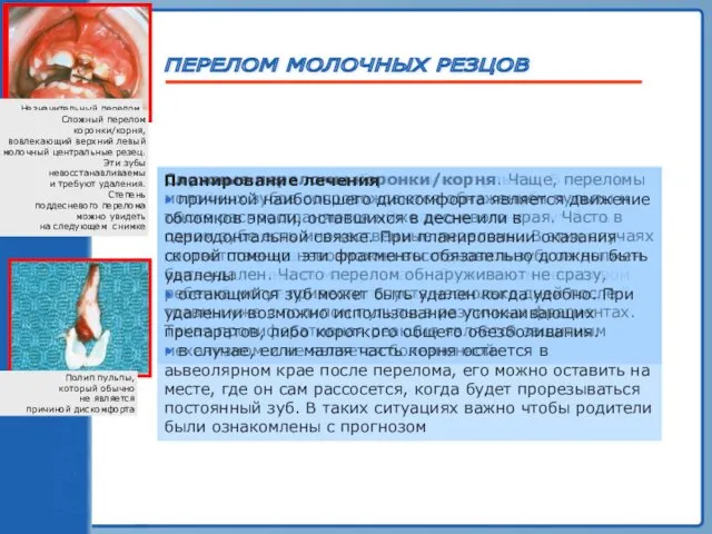 ТРАВМА ЗУБА ПЕРЕЛОМ МОЛОЧНЫХ РЕЗЦОВ Перелом коронки с обнажением пульпы. В отличие от