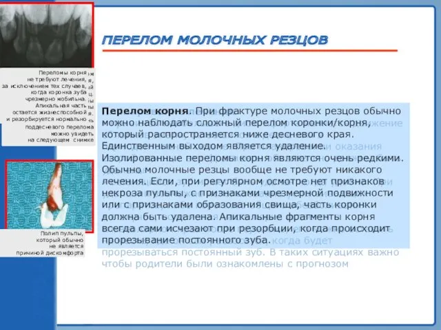 ТРАВМА ЗУБА ПЕРЕЛОМ МОЛОЧНЫХ РЕЗЦОВ Полип пульпы, который обычно не является причиной дискомфорта