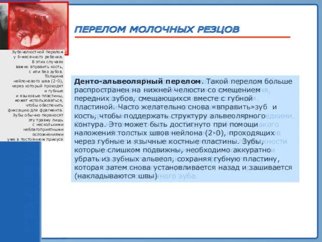 ТРАВМА ЗУБА ПЕРЕЛОМ МОЛОЧНЫХ РЕЗЦОВ Перелом корня. При фрактуре молочных резцов обычно можно