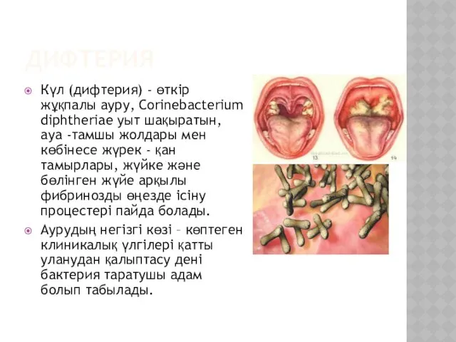 ДИФТЕРИЯ Күл (дифтерия) - өткір жұқпалы ауру, Corinebacterium diphtheriae уыт шақыратын, ауа -тамшы