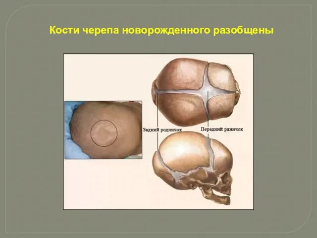 Кости черепа новорожденного разобщены