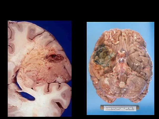 Макропрепаратат Инфарк головного мозга (просмотр)