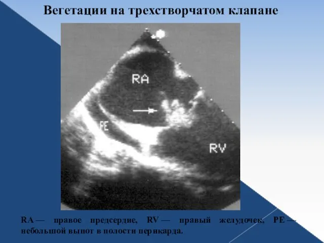 Вегетации на трехстворчатом клапане RA — правое предсердие, RV — правый желудочек, PE