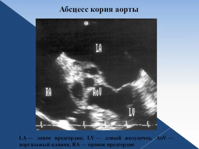 Абсцесс корня аорты LA — левое предсердие, LV — левый желудочек, AoV —