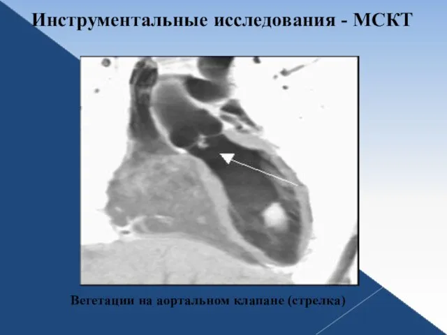 Инструментальные исследования - МСКТ Вегетации на аортальном клапане (стрелка)