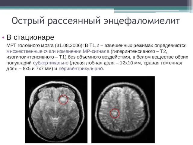Острый рассеянный энцефаломиелит В стационаре МРТ головного мозга (31.08.2006): В