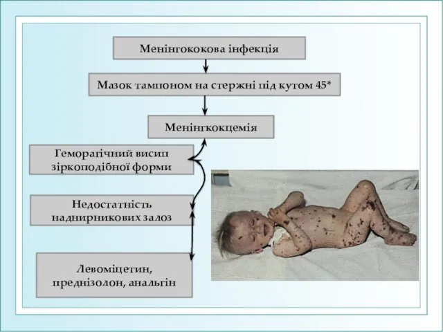 Менінгококова інфекція Мазок тампоном на стержні під кутом 45* Менінгкокцемія