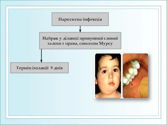 Паротитна інфекція Набряк у ділянці привушної слиної залози з права, симптом Мурсу Термін ізоляції 9 днів