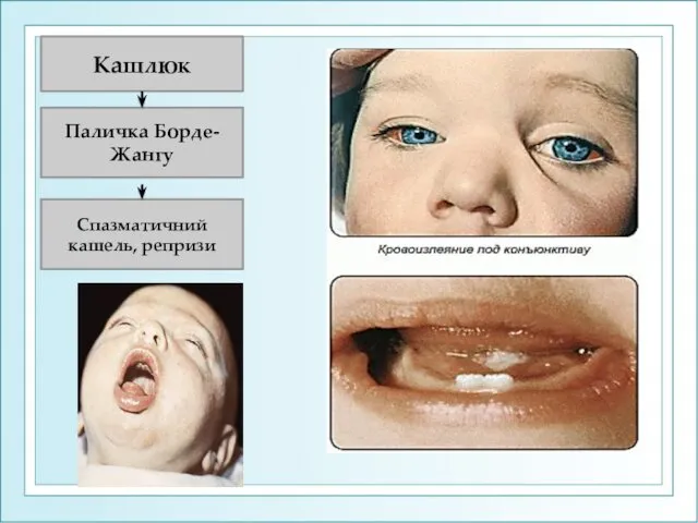 Кашлюк Паличка Борде-Жангу Спазматичний кашель, репризи