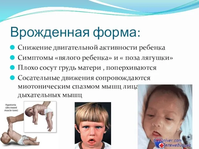 Врожденная форма: Снижение двигательной активности ребенка Симптомы «вялого ребенка» и