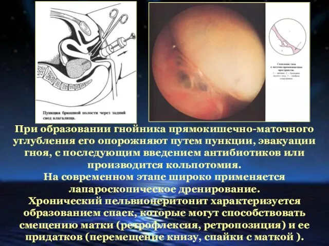 При образовании гнойника прямокишечно-маточного углубления его опорожняют путем пункции, эвакуации