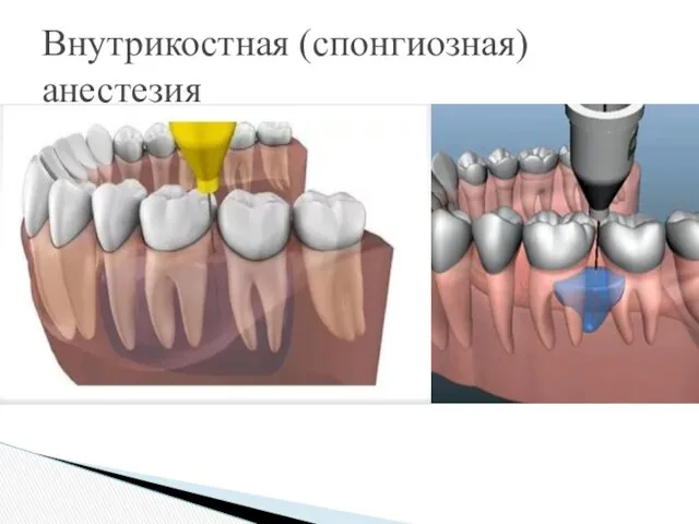 Внутрикостная (спонгиозная) анестезия