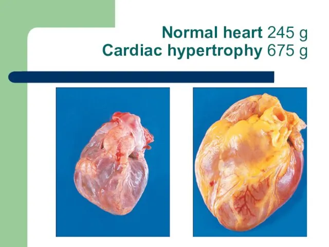 Normal heart 245 g Cardiac hypertrophy 675 g