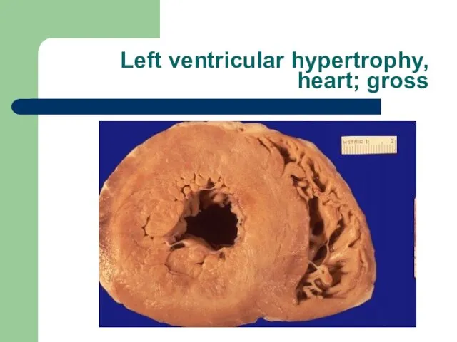 Left ventricular hypertrophy, heart; gross