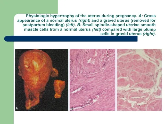 Physiologic hypertrophy of the uterus during pregnancy. A: Gross appearance