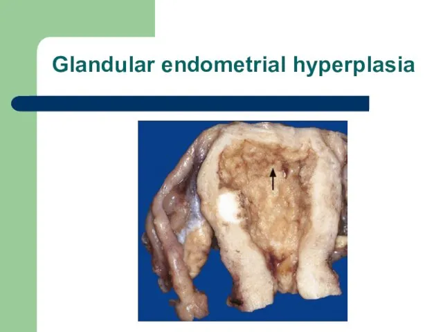 Glandular endometrial hyperplasia