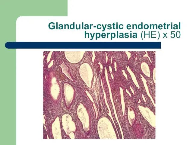 Glandular-cystic endometrial hyperplasia (HE) x 50