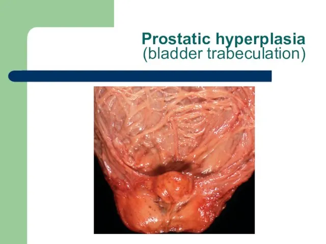 Prostatic hyperplasia (bladder trabeculation)