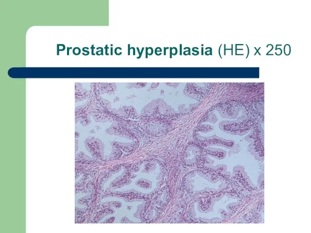 Prostatic hyperplasia (HE) x 250