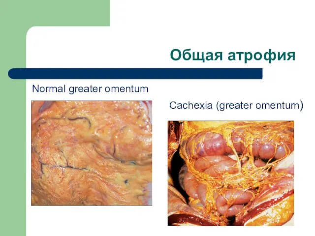 Общая атрофия Normal greater omentum Cachexia (greater omentum)