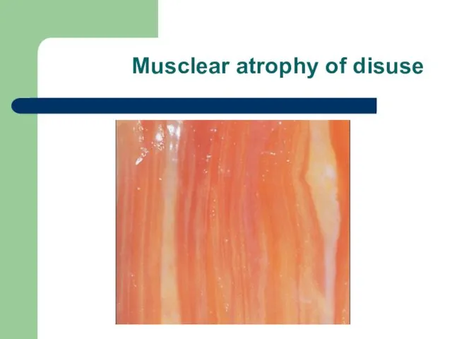 Musclear atrophy of disuse