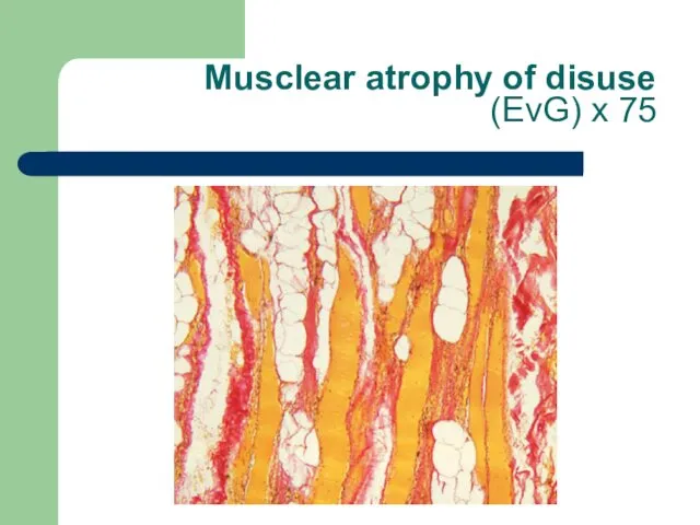 Musclear atrophy of disuse (EvG) x 75