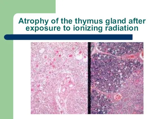 Atrophy of the thymus gland after exposure to ionizing radiation