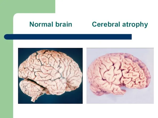 Normal brain Cerebral atrophy