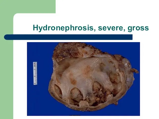 Hydronephrosis, severe, gross