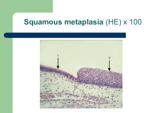 Squamous metaplasia (HE) x 100