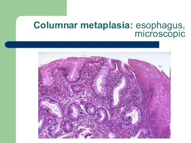 Columnar metaplasia: esophagus, microscopic