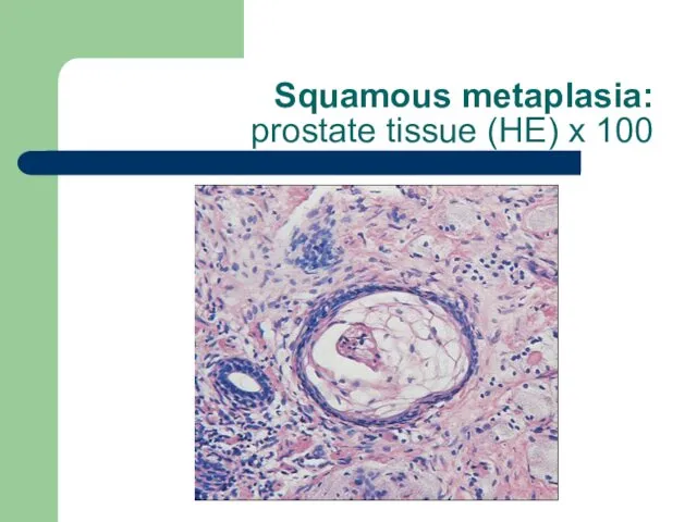 Squamous metaplasia: prostate tissue (HE) x 100