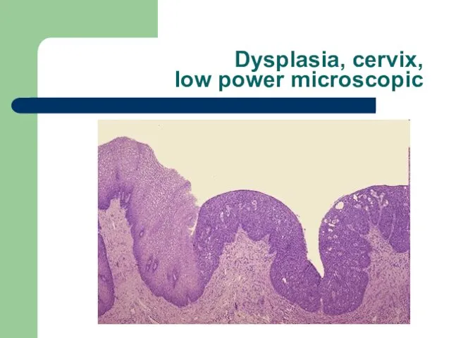 Dysplasia, cervix, low power microscopic