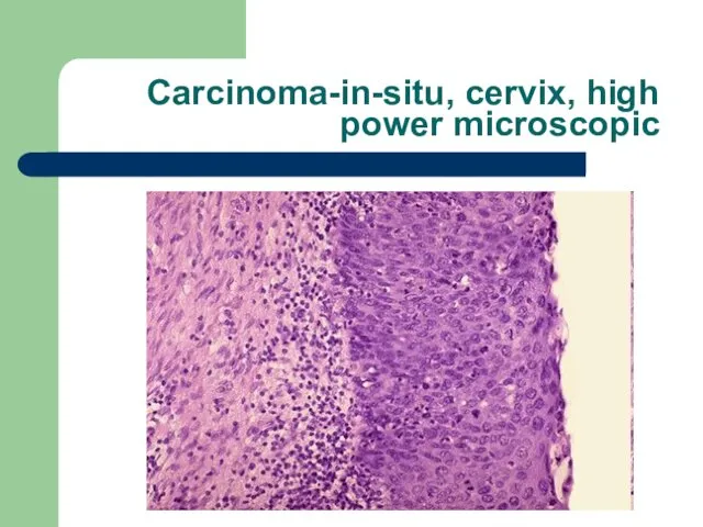 Carcinoma-in-situ, cervix, high power microscopic