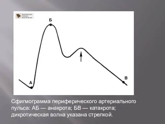 Сфигмограмма периферического артериального пульса: АБ — анакрота; БВ — катакрота; дикротическая волна указана стрелкой.