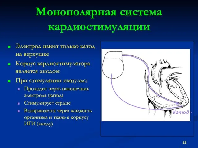 Монополярная система кардиостимуляции Электрод имеет только катод на верхушке Корпус