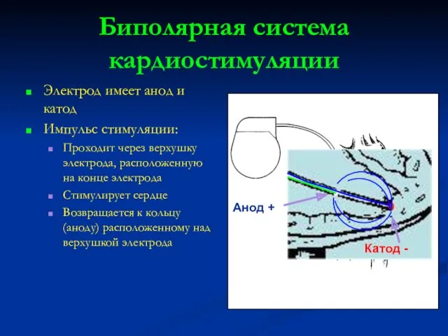 Anode Биполярная система кардиостимуляции Электрод имеет анод и катод Импульс