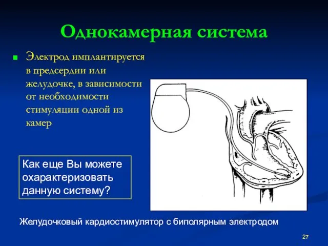 Однокамерная система Электрод имплантируется в предсердии или желудочке, в зависимости