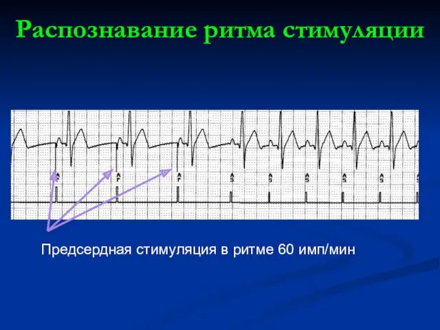 Распознавание ритма стимуляции Предсердная стимуляция в ритме 60 имп/мин