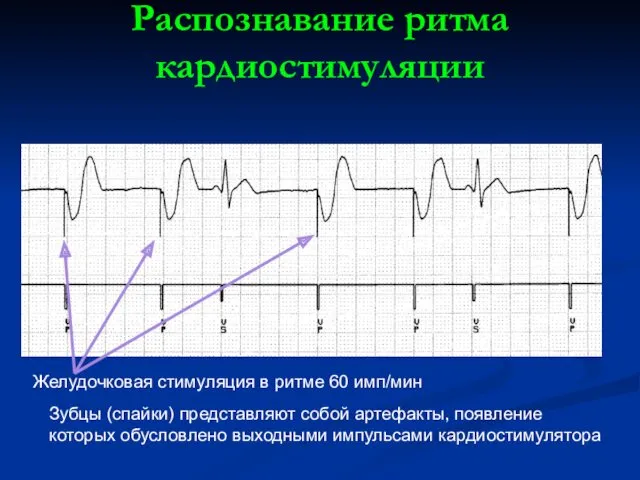 Распознавание ритма кардиостимуляции Желудочковая стимуляция в ритме 60 имп/мин Зубцы