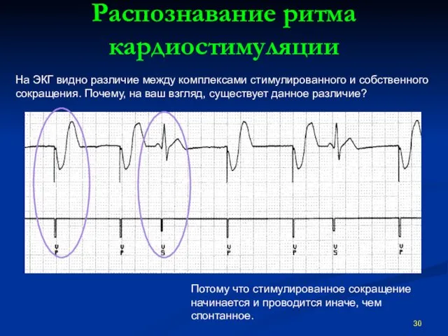 Распознавание ритма кардиостимуляции На ЭКГ видно различие между комплексами стимулированного