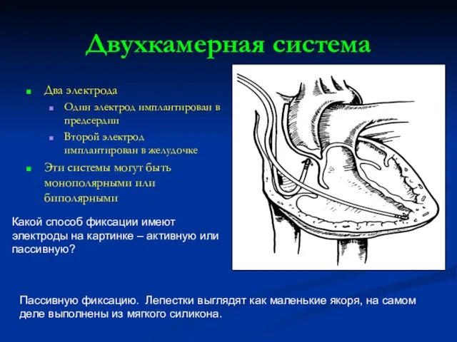 Двухкамерная система Два электрода Один электрод имплантирован в предсердии Второй