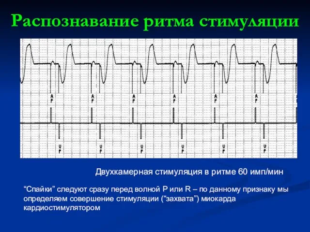 Распознавание ритма стимуляции Двухкамерная стимуляция в ритме 60 имп/мин “Спайки”