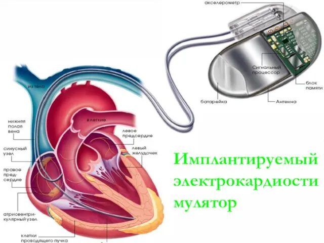 Имплантируемый электрокардиостимулятор