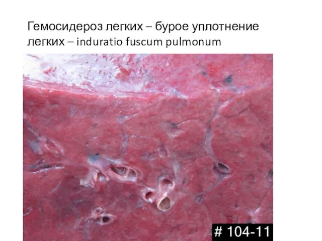 Гемосидероз легких – бурое уплотнение легких – induratio fuscum pulmonum